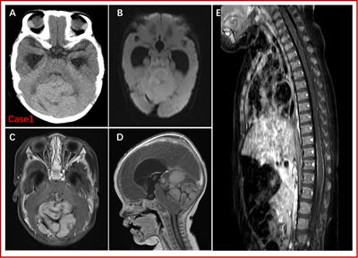 Congenital medulloblastoma in two <mark class="highlighted">brothers</mark> with SUFU-mutated Gorlin-Goltz syndrome: Case reports and literature review